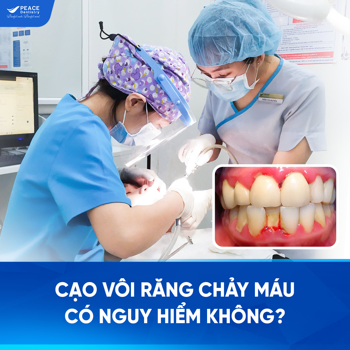 cạo vôi răng chảy máu