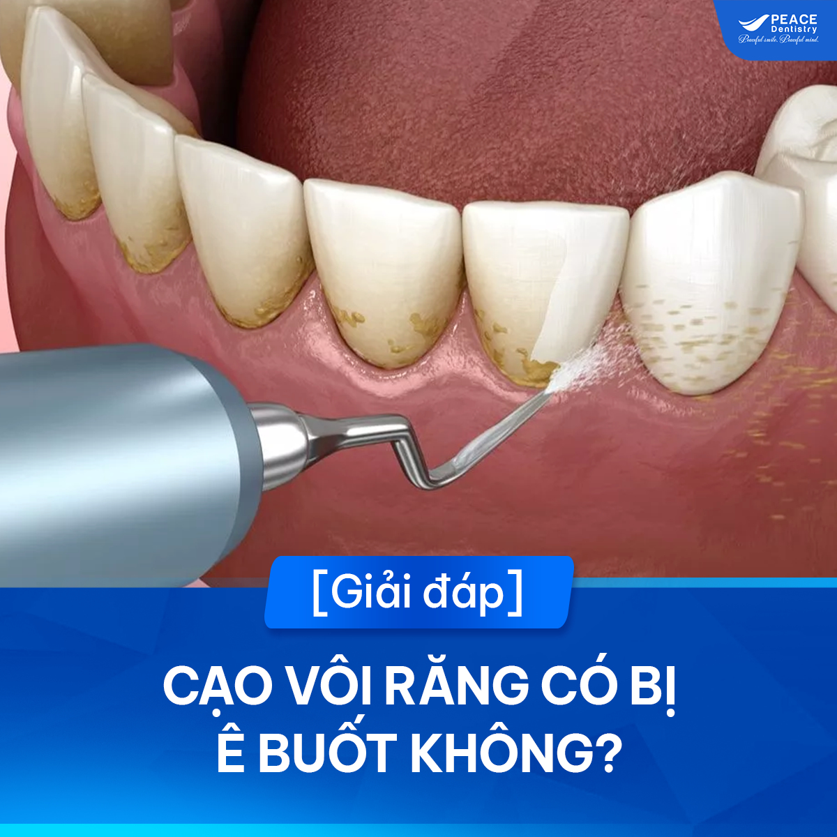 cạo vôi răng có bị ê buốt không