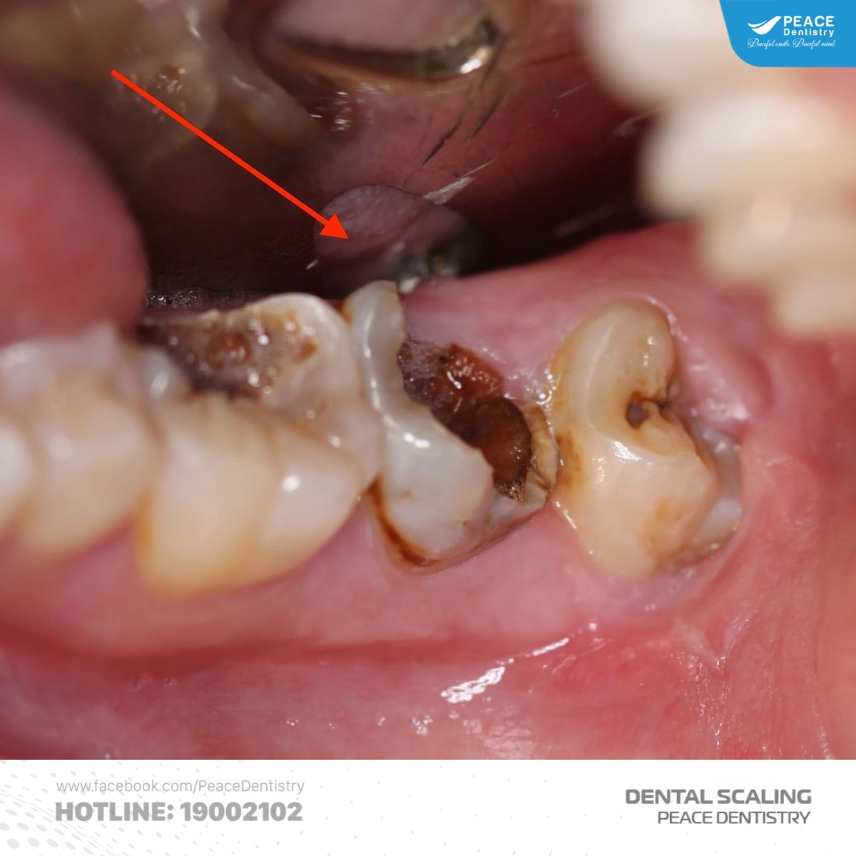 cạo vôi răng có tốt không