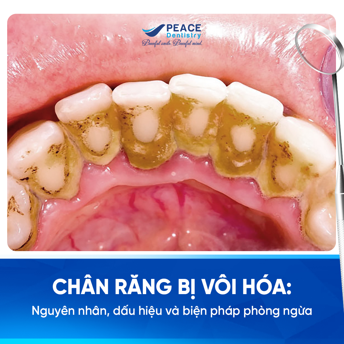 chân răng bị vôi hóa