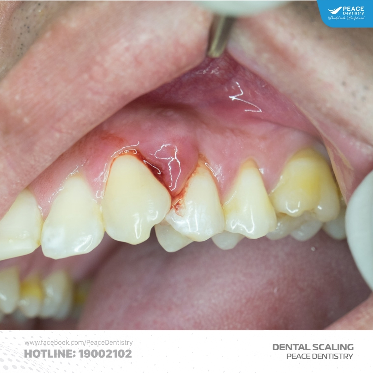 có nên cạo vôi và tẩy trắng răng cùng lúc không