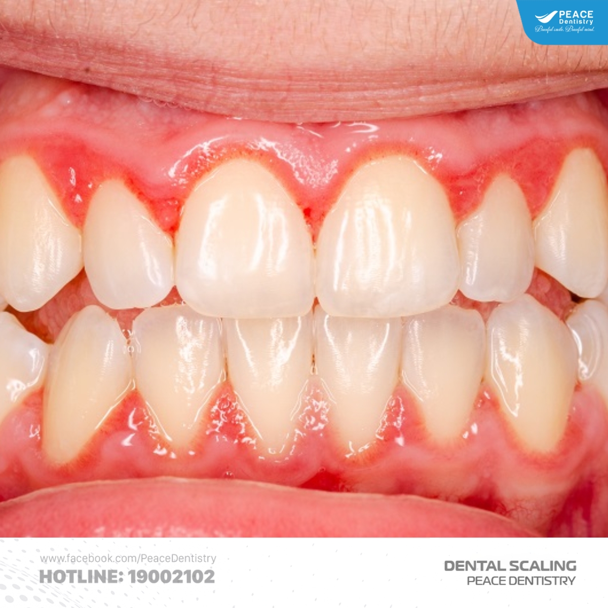 dấu hiệu nhận biết cao răng độ 4