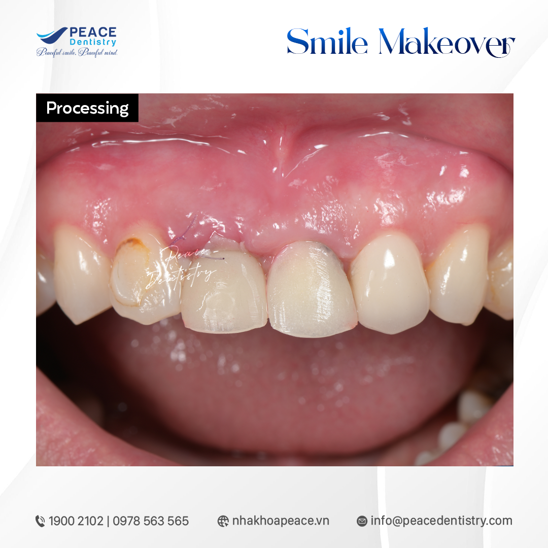 phẫu thuật implant và tái tạo mô