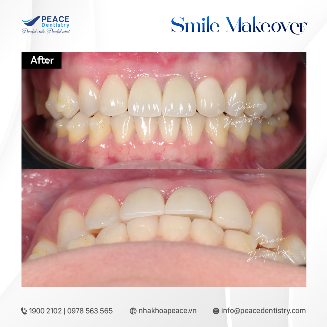 giai đoạn 3 phục hình thẩm mỹ sau cùng