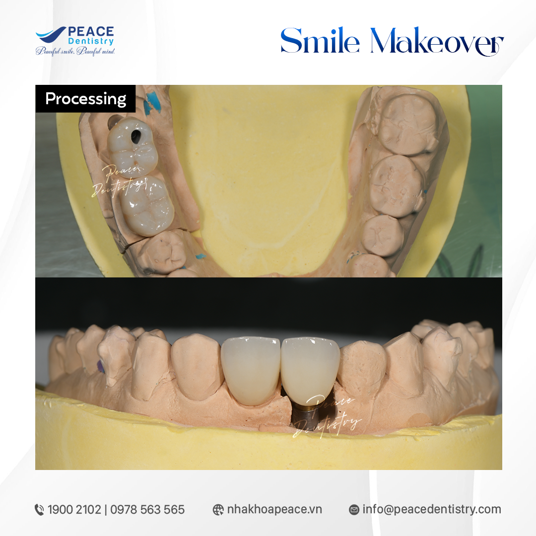 giai đoạn 3 phục hình thẩm mỹ