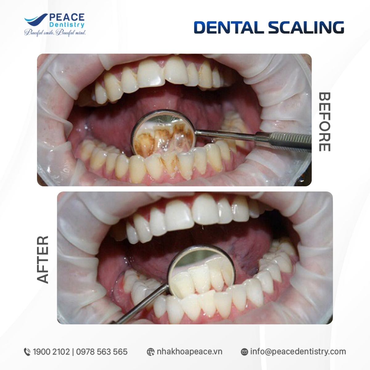 hình ảnh cạo vôi răng tại peace dentistry