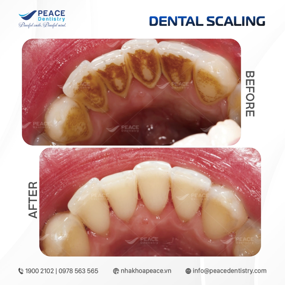 hình ảnh lấy cao răng quận 3