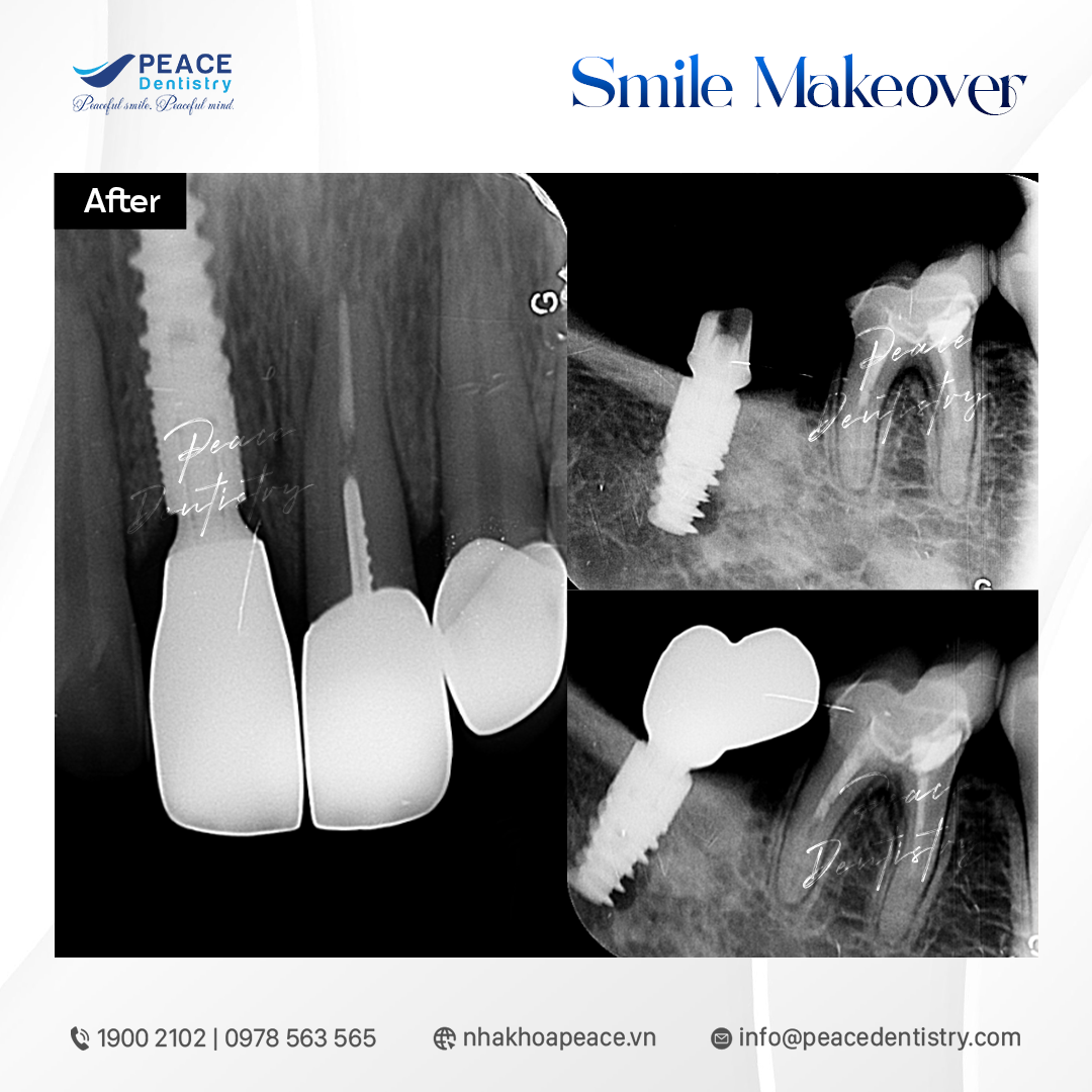 kết quả phục hình
