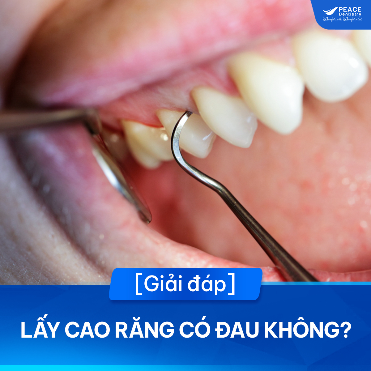 lấy cao răng có đau không