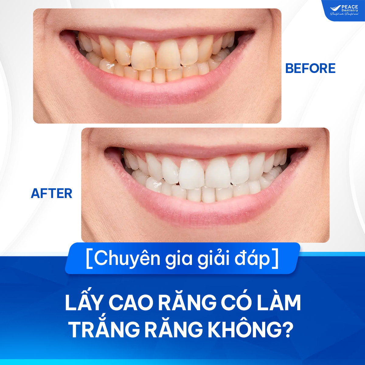 lấy cao răng có làm trắng răng không