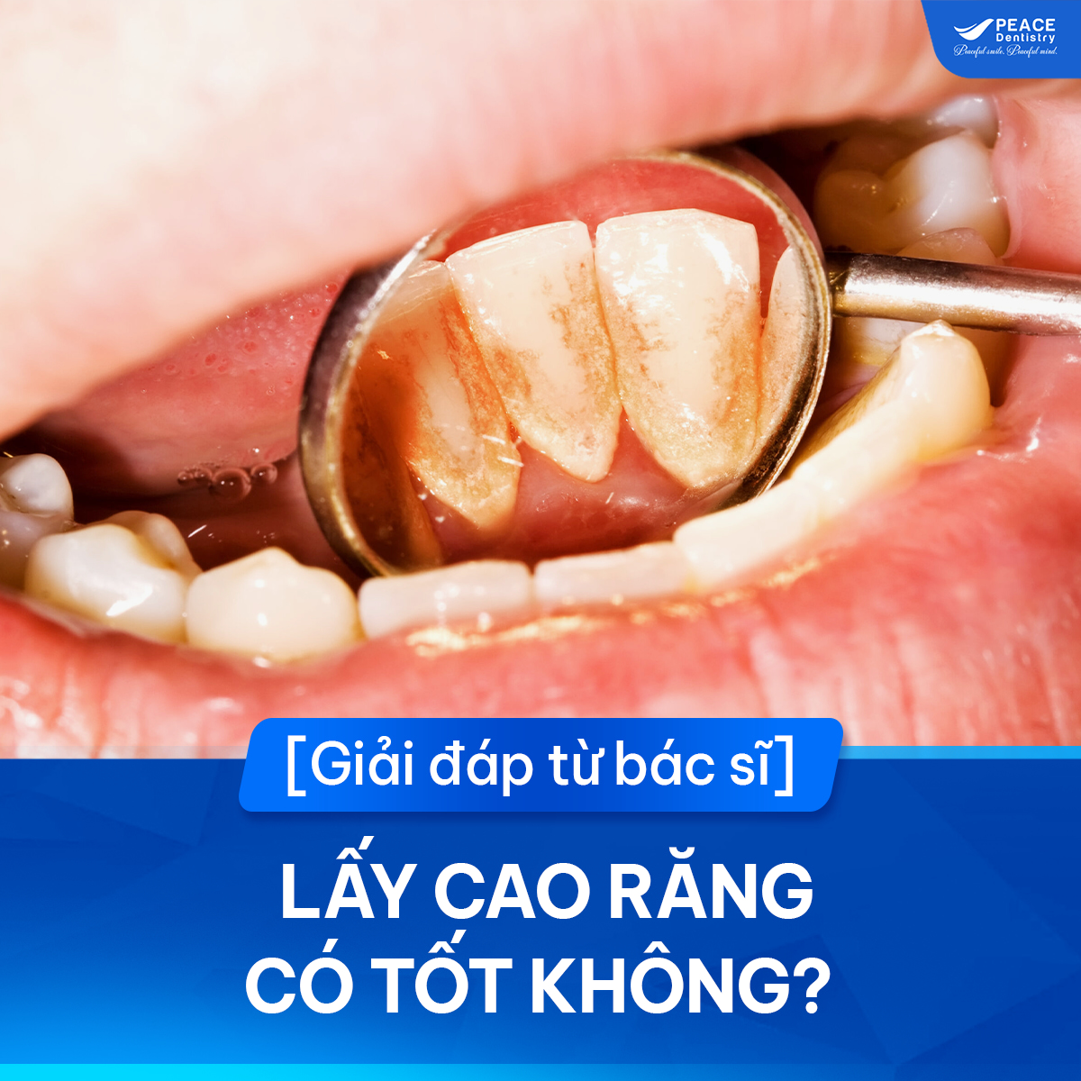 lấy cao răng có tốt không