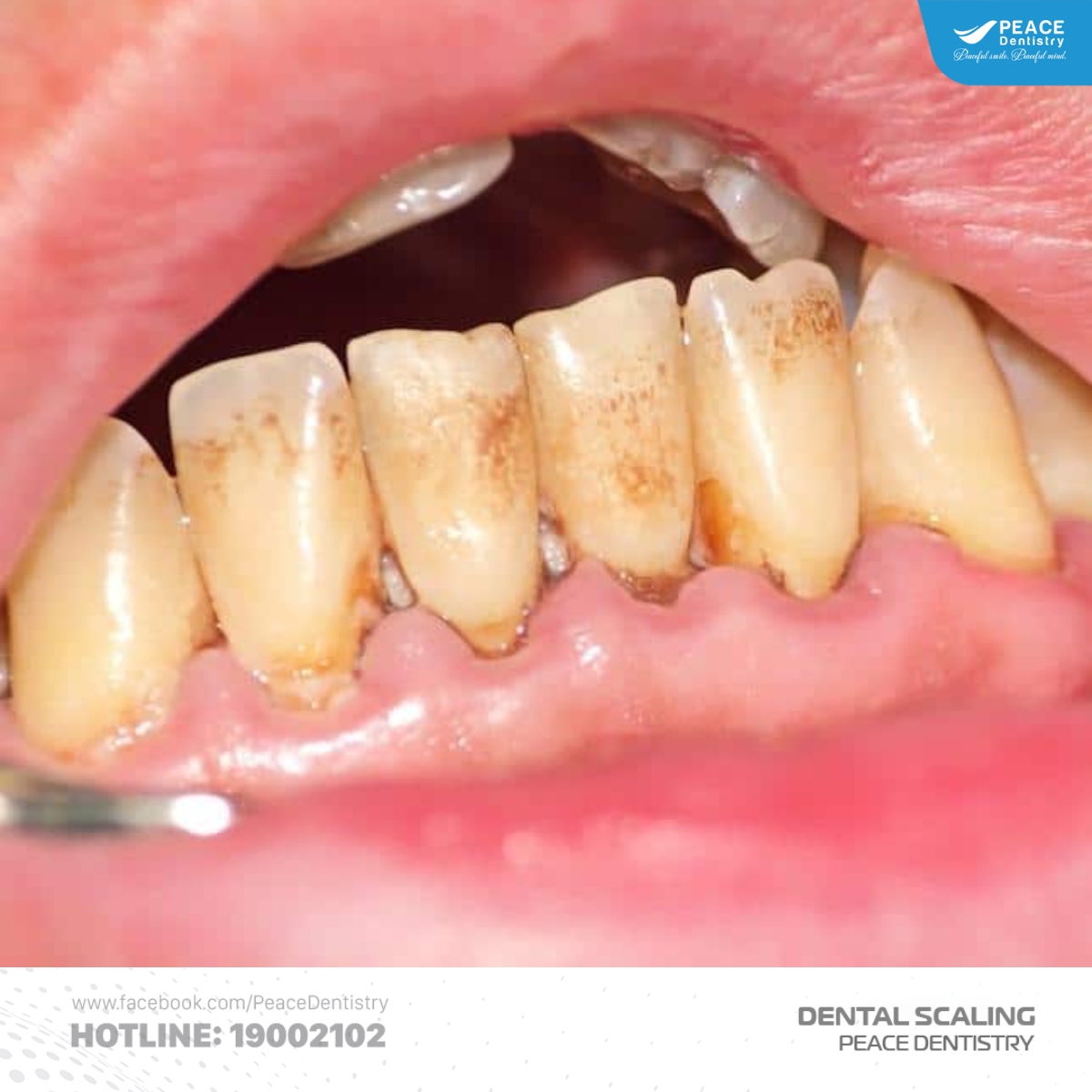 lấy cao răng có đau không tùy vào tình trạng răng miệng