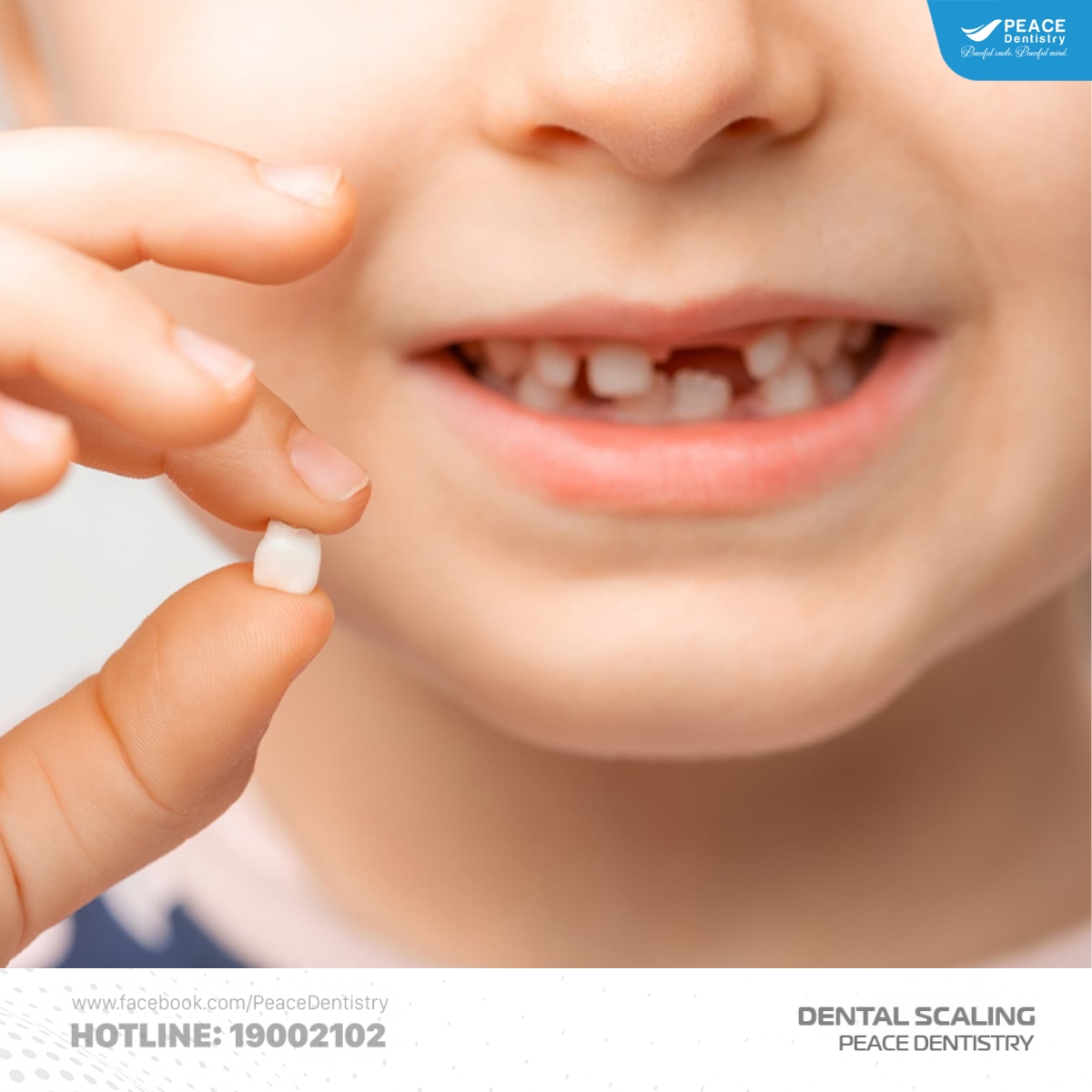 lấy cao răng định kỳ ngăn ngừa rụng răng sữa sớm