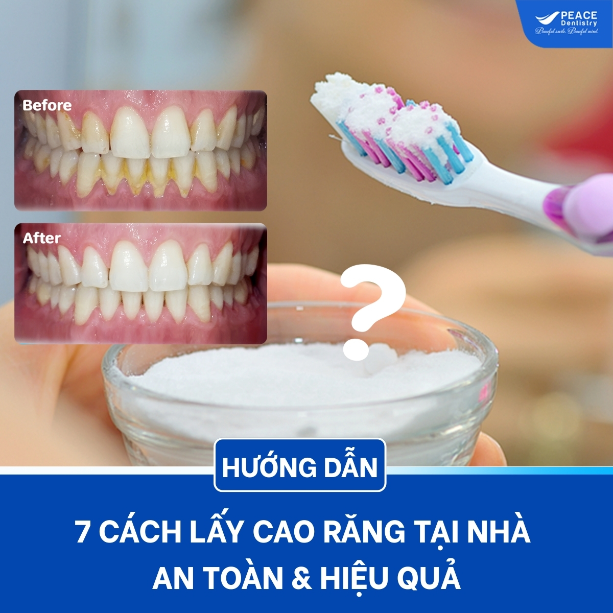 cách lấy cao răng tại nhà