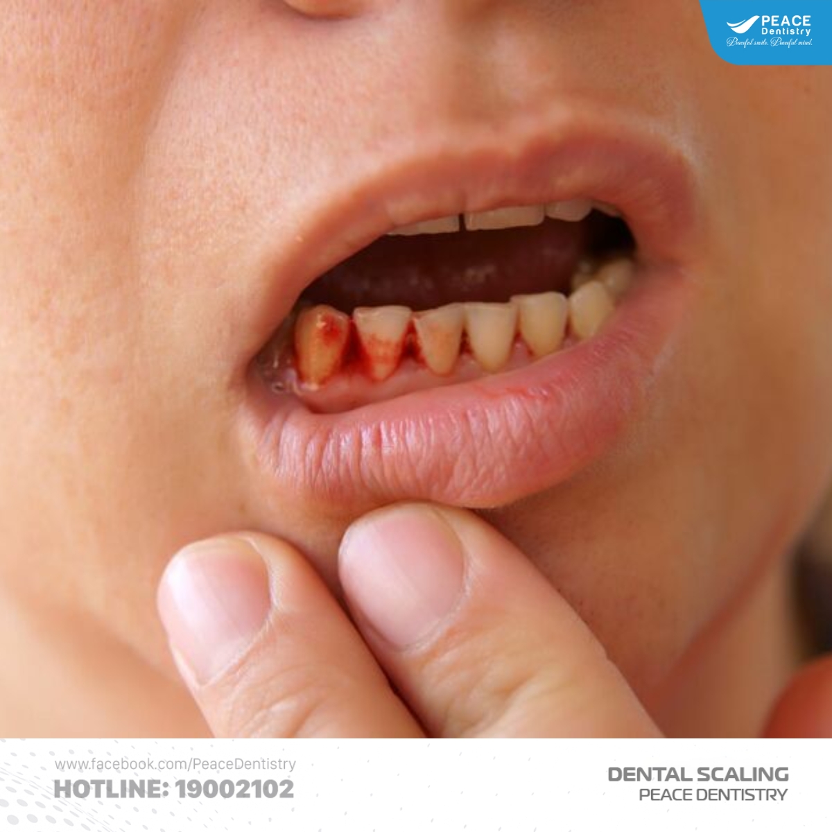 lấy vôi răng sai cách làm tổn thương mô mềm