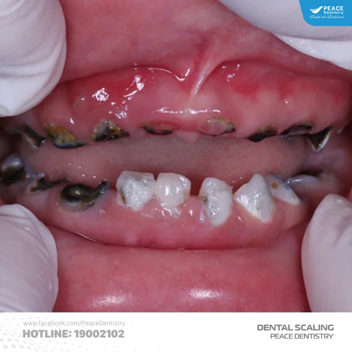 lợi ích khi lấy cao răng định kỳ cho trẻ