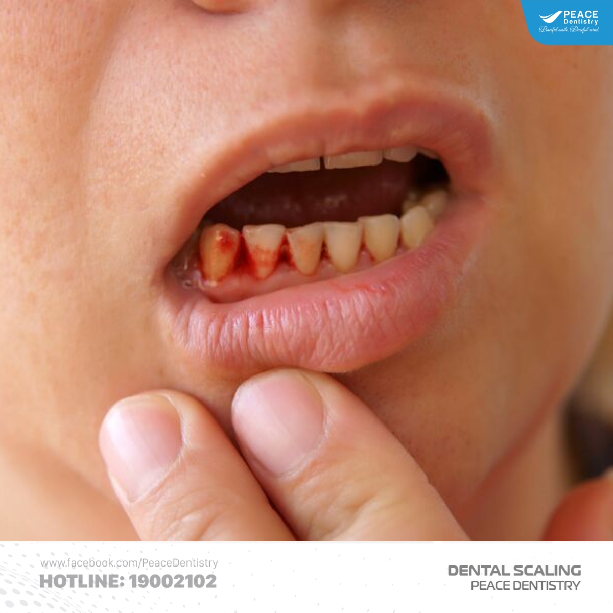 mức độ chảy máu khi cạo vôi răng