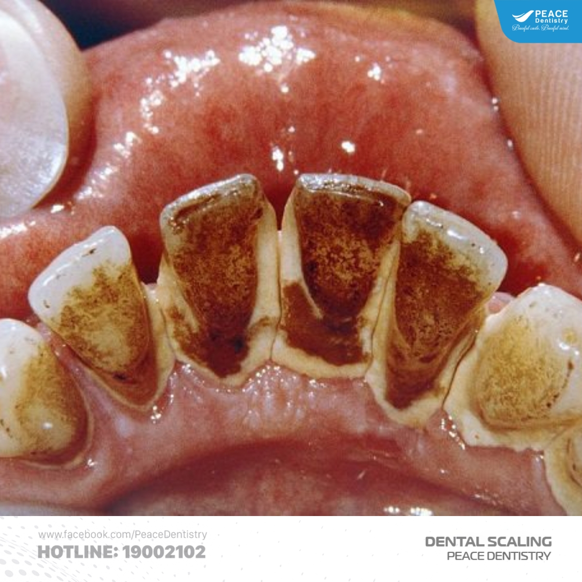 nguyên nhân chảy máu khi cạo vôi răng