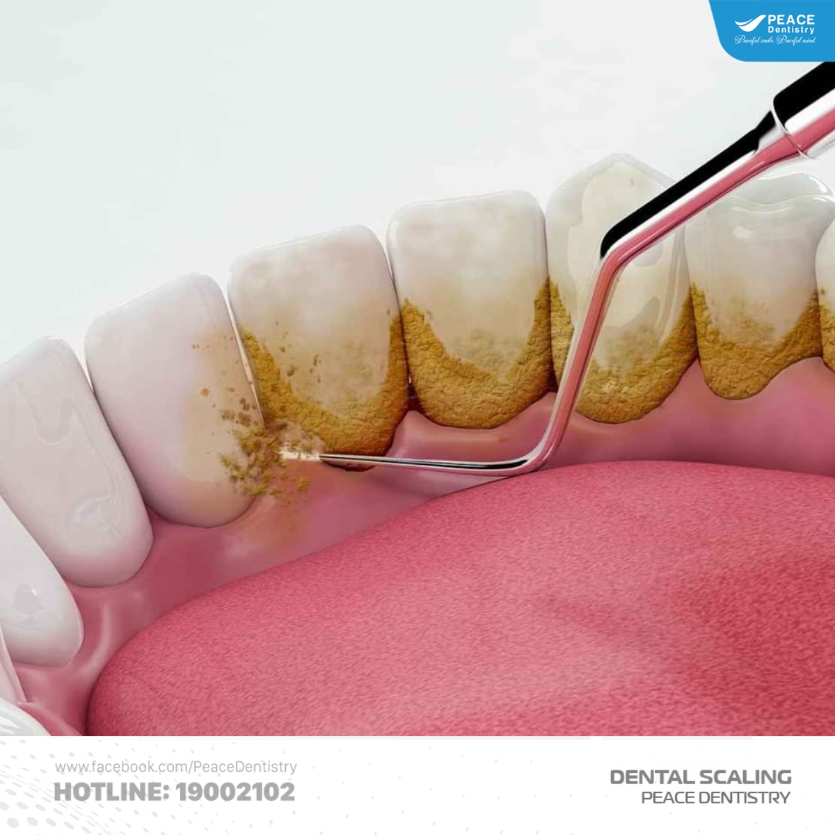 răng sứ có cần cạo vôi răng không