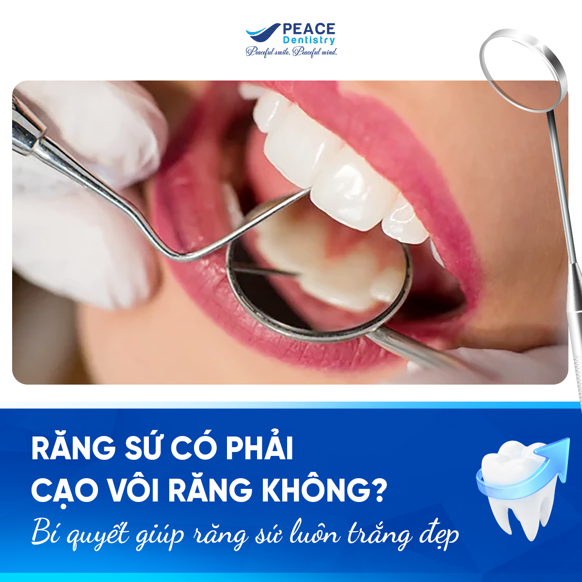 răng sứ có phải cạo vôi răng không