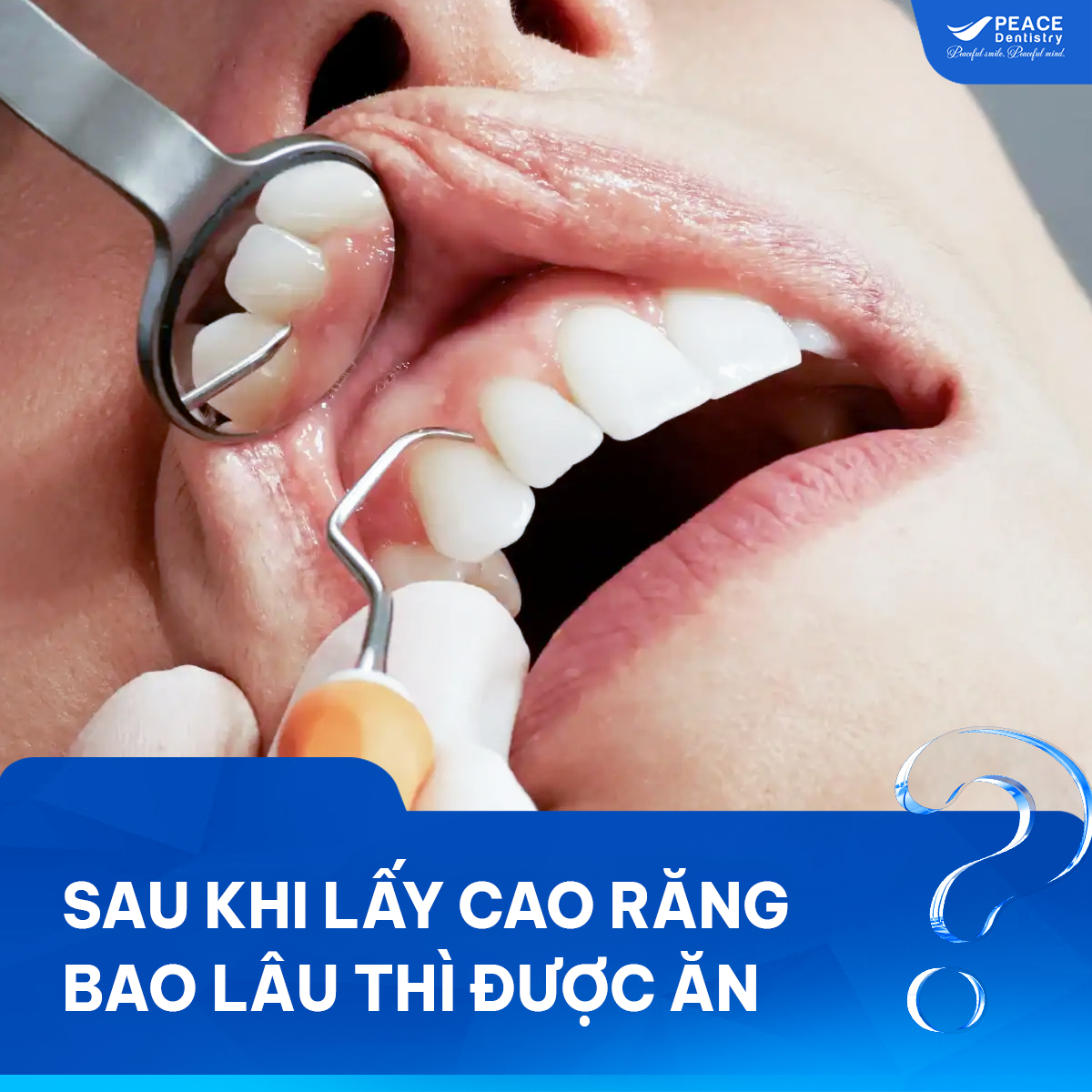 sau khi lấy cao răng bao lâu thì được ăn