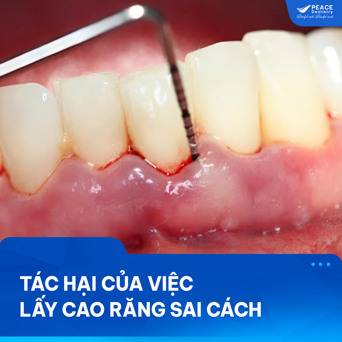 tác hại của việc lấy cao răng sai cách