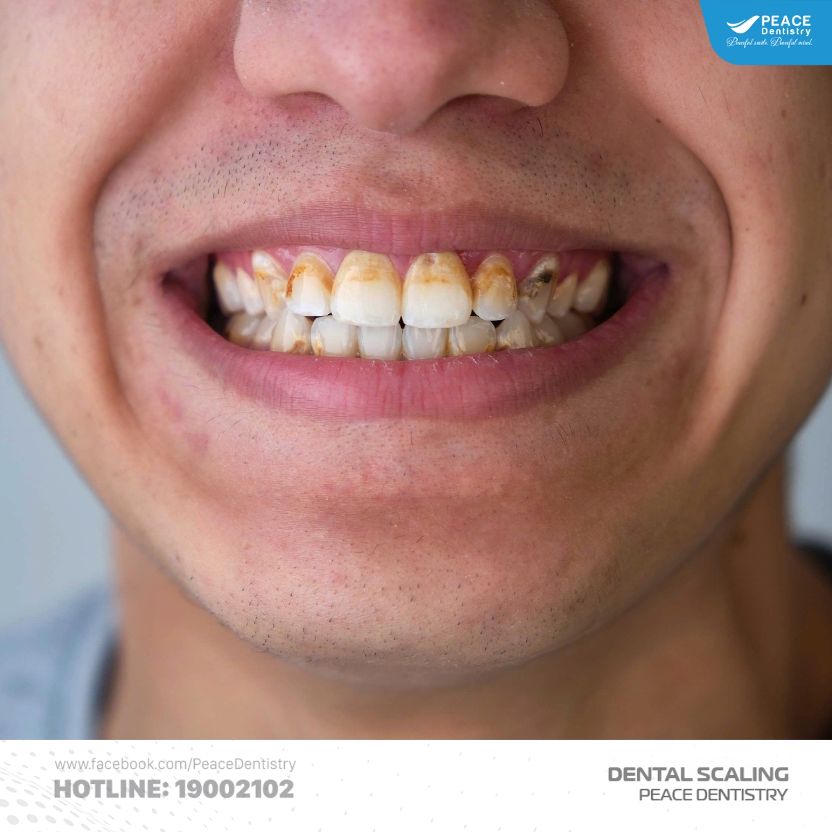 vì sao cạo vôi răng bị ê buốt