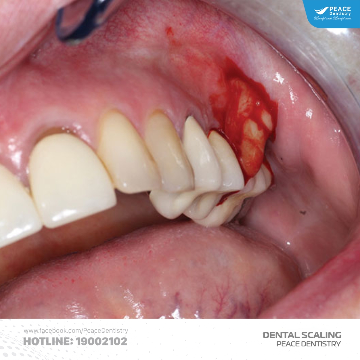 viêm nướu khi lấy vôi răng sai cách