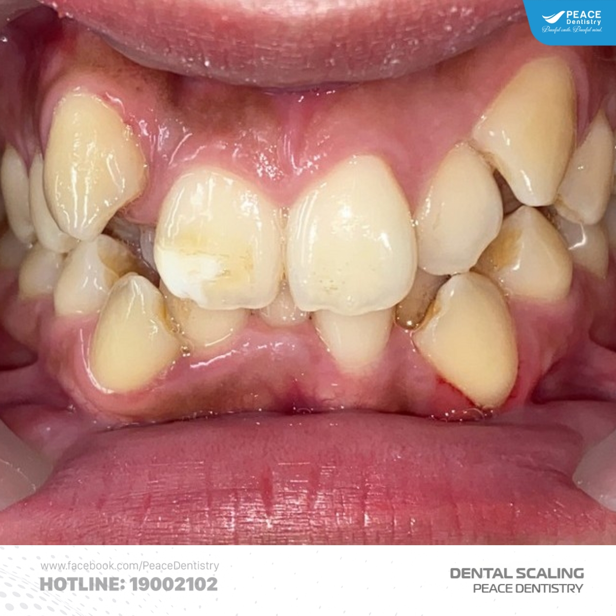 vôi hóa chân răng do đâu