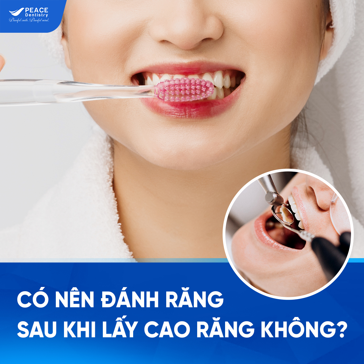 có nên đánh răng sau khi lấy cao răng