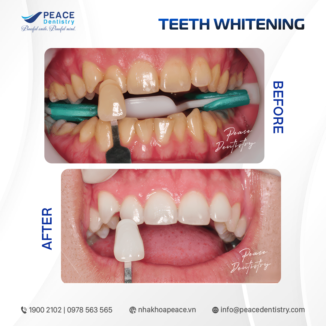 hình ảnh khách hàng tẩy trắng răng