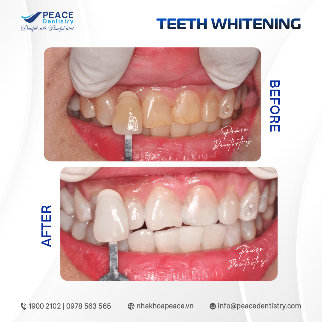 hình ảnh tẩy trắng răng nhiễm fluor