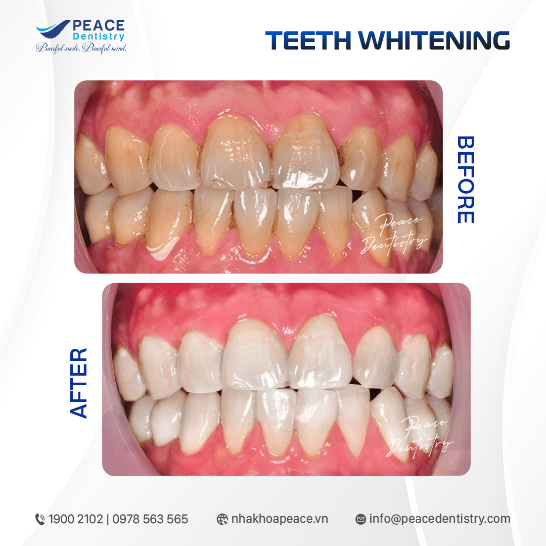 hình ảnh trước và sau tẩy trắng răng