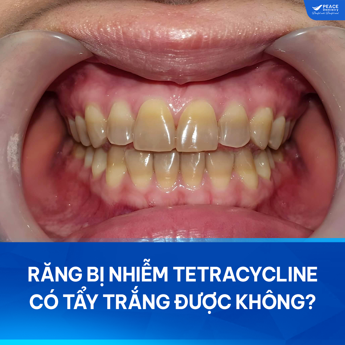 răng bị nhiễm tetracycline có tẩy trắng được không