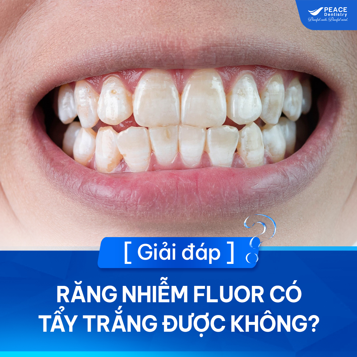 răng nhiễm fluor có tẩy trắng được không