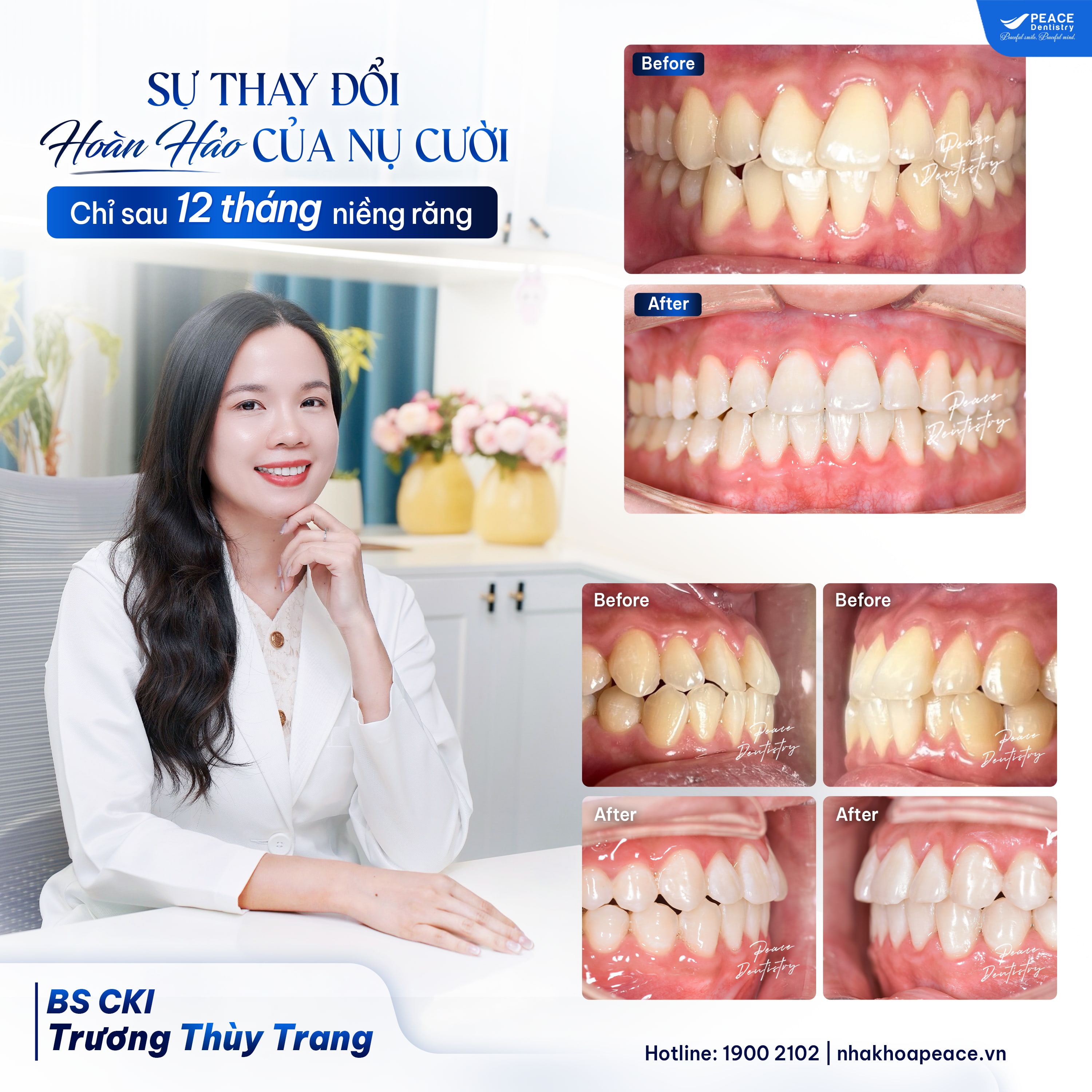 case niềng răng khớp cắn chéo cho khách hàng u40