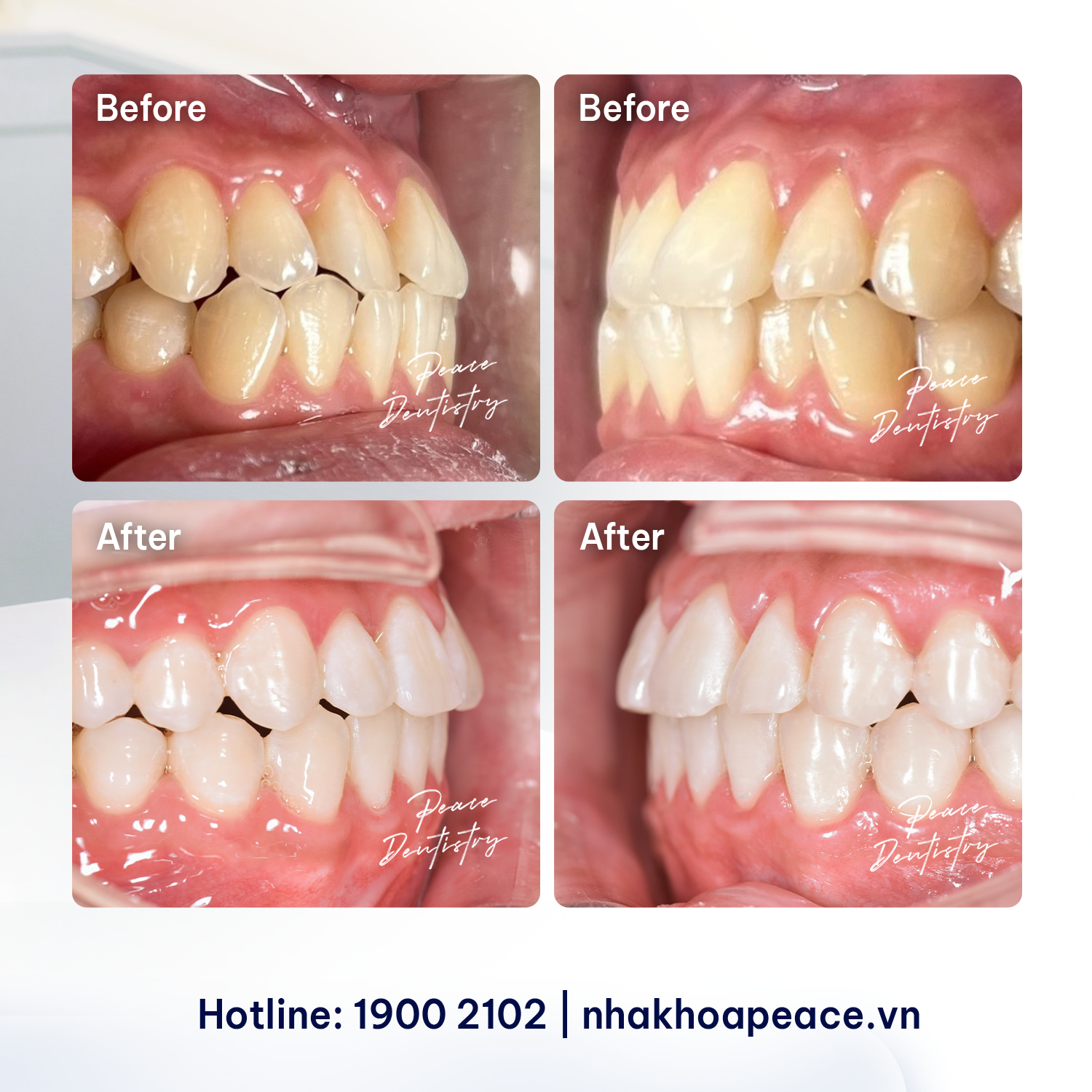 case niềng răng khớp cắn chéo cho khách hàng nam u40