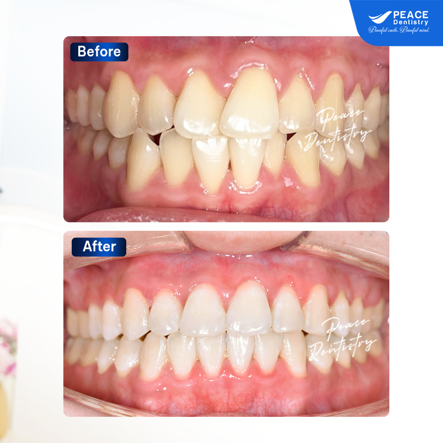 case niềng răng khớp cắn chéo