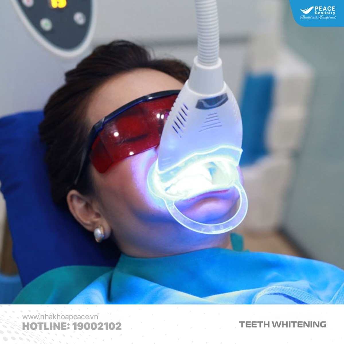 công nghệ tẩy trắng răng hiện đại bằng ánh sáng xanh