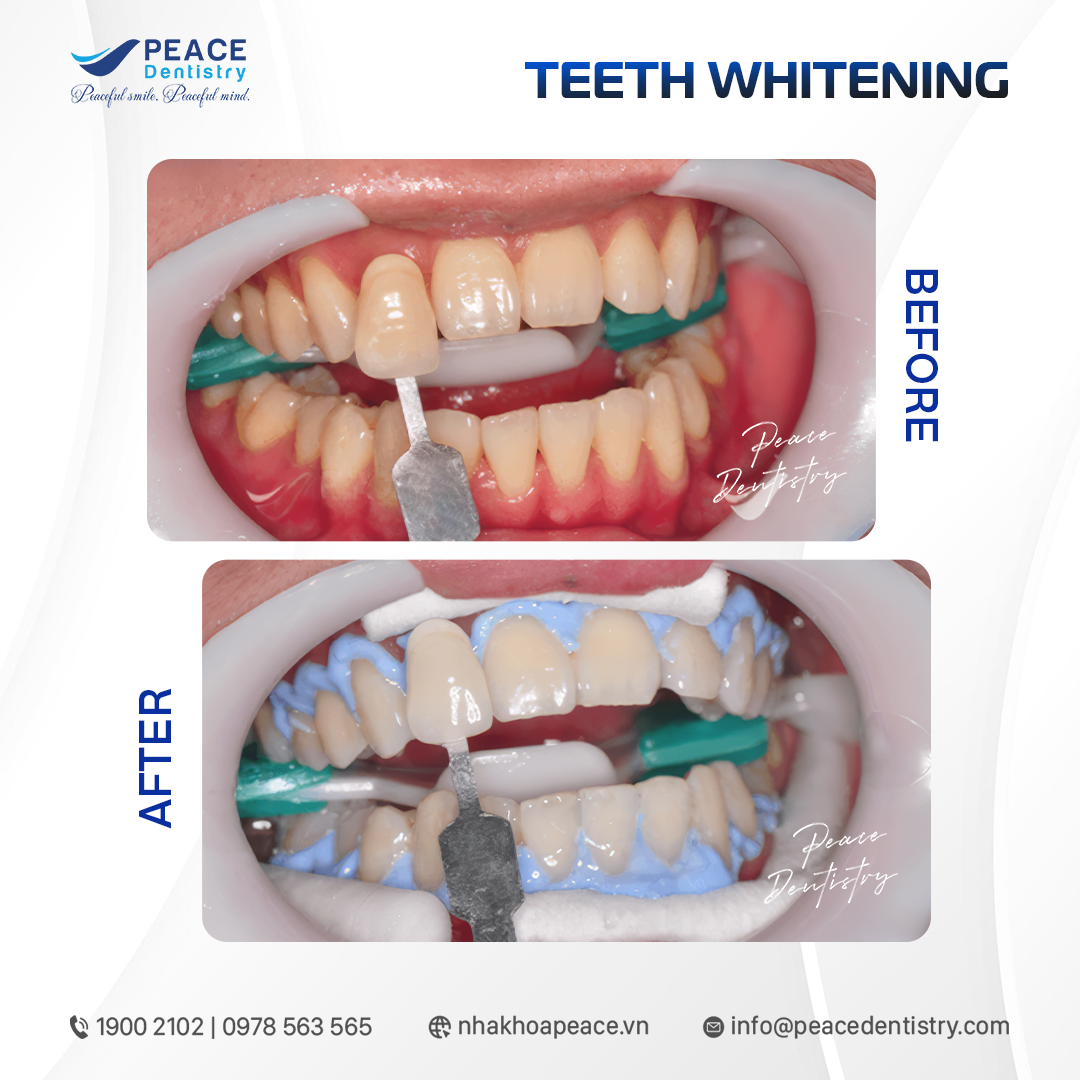 hiệu quả tẩy trắng răng tại quận 7