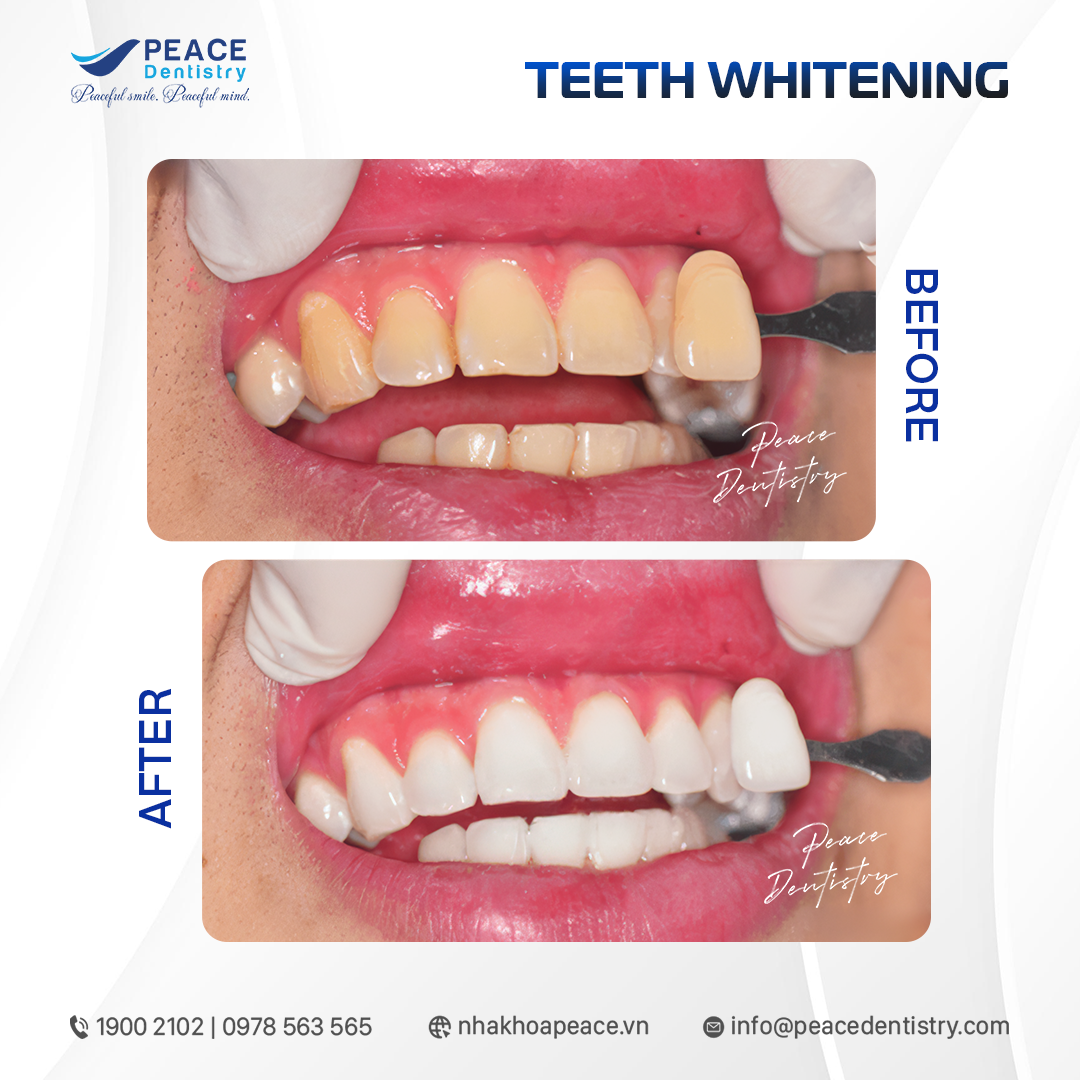 hình ảnh khách hàng tẩy trắng răng tại thủ đức