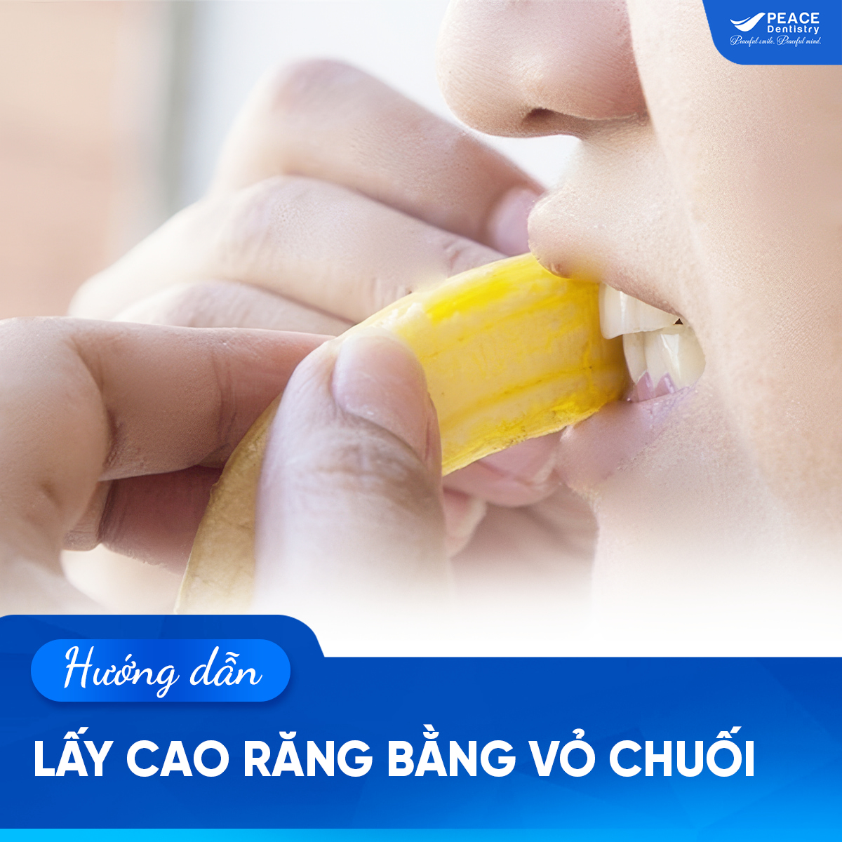 lấy cao răng bằng vỏ chuối