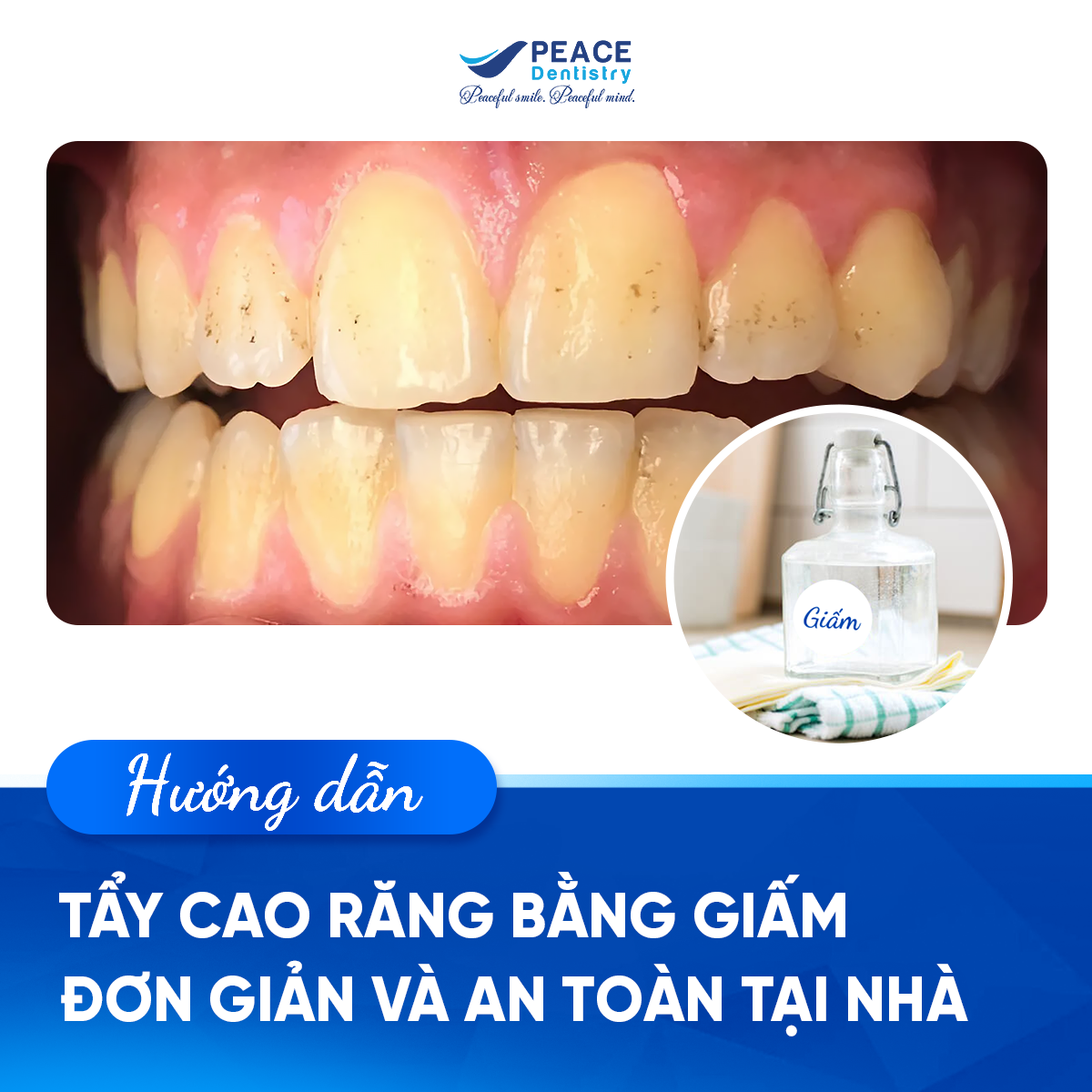 lấy cao răng tại nhà bằng giấm