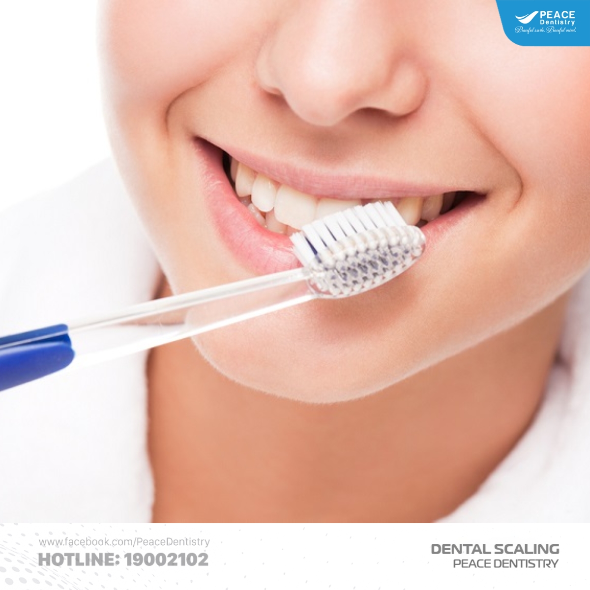 lưu ý hạn chế cao răng