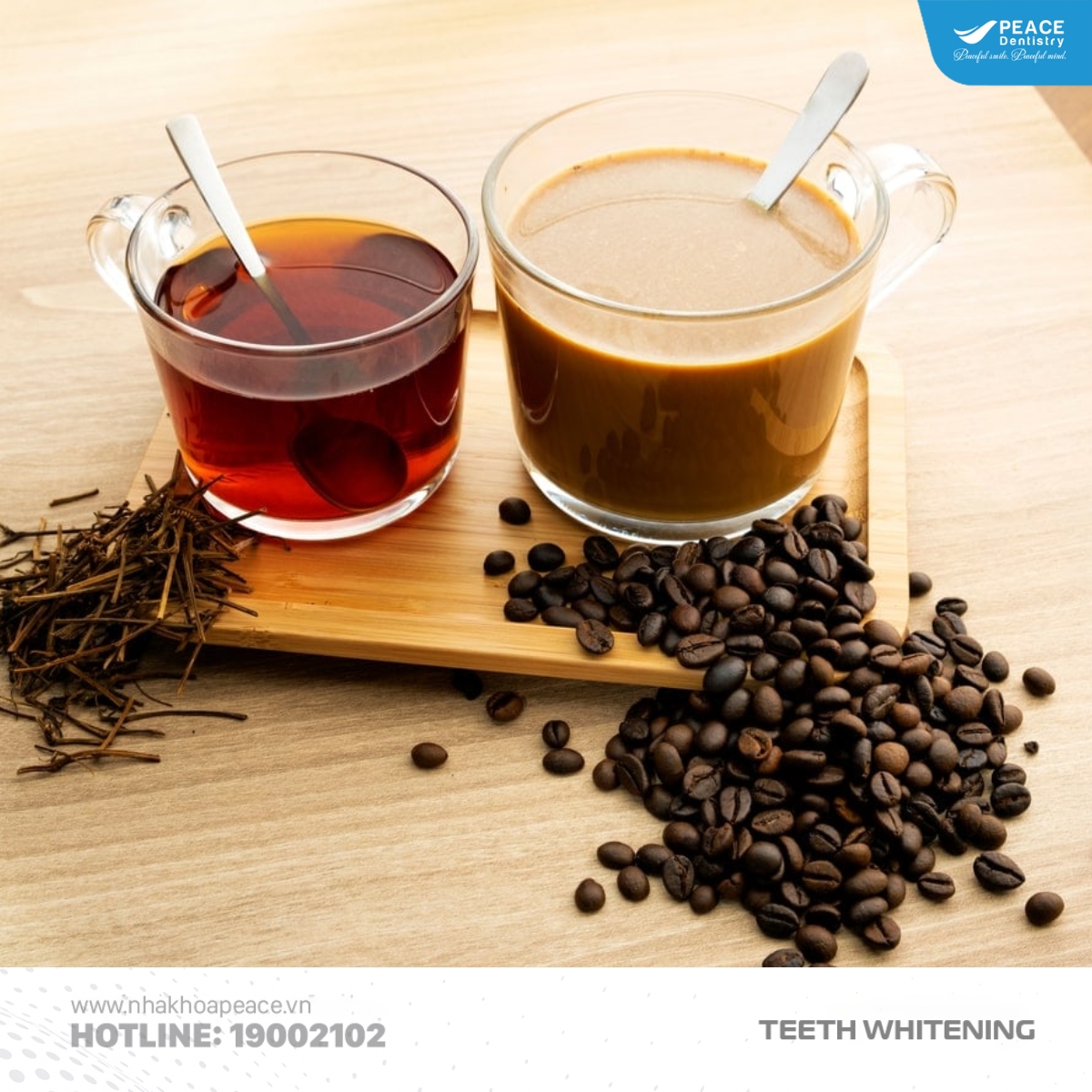 lưu ý sau khi ngậm máng tẩy trắng răng