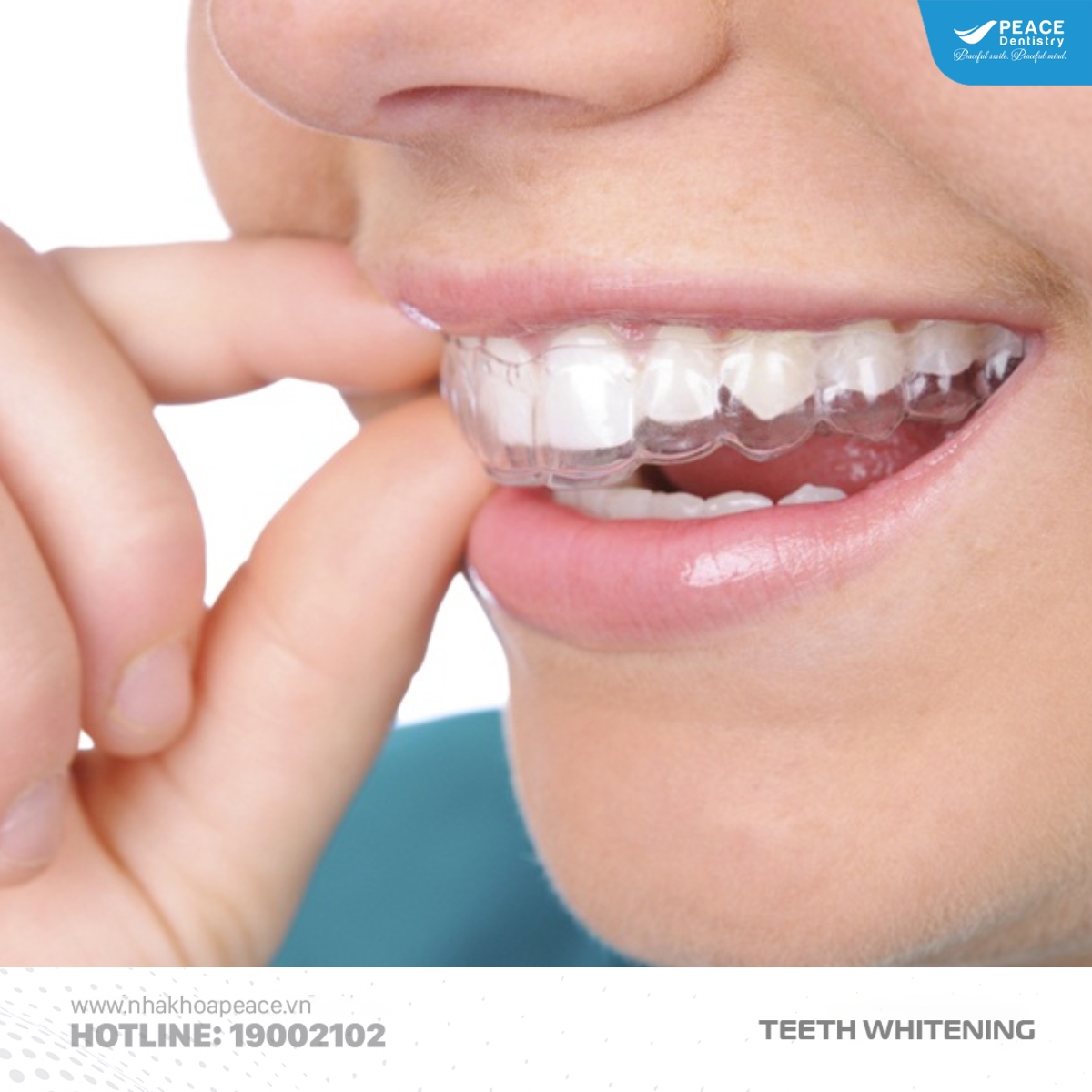 máng tẩy trắng răng tại nhà