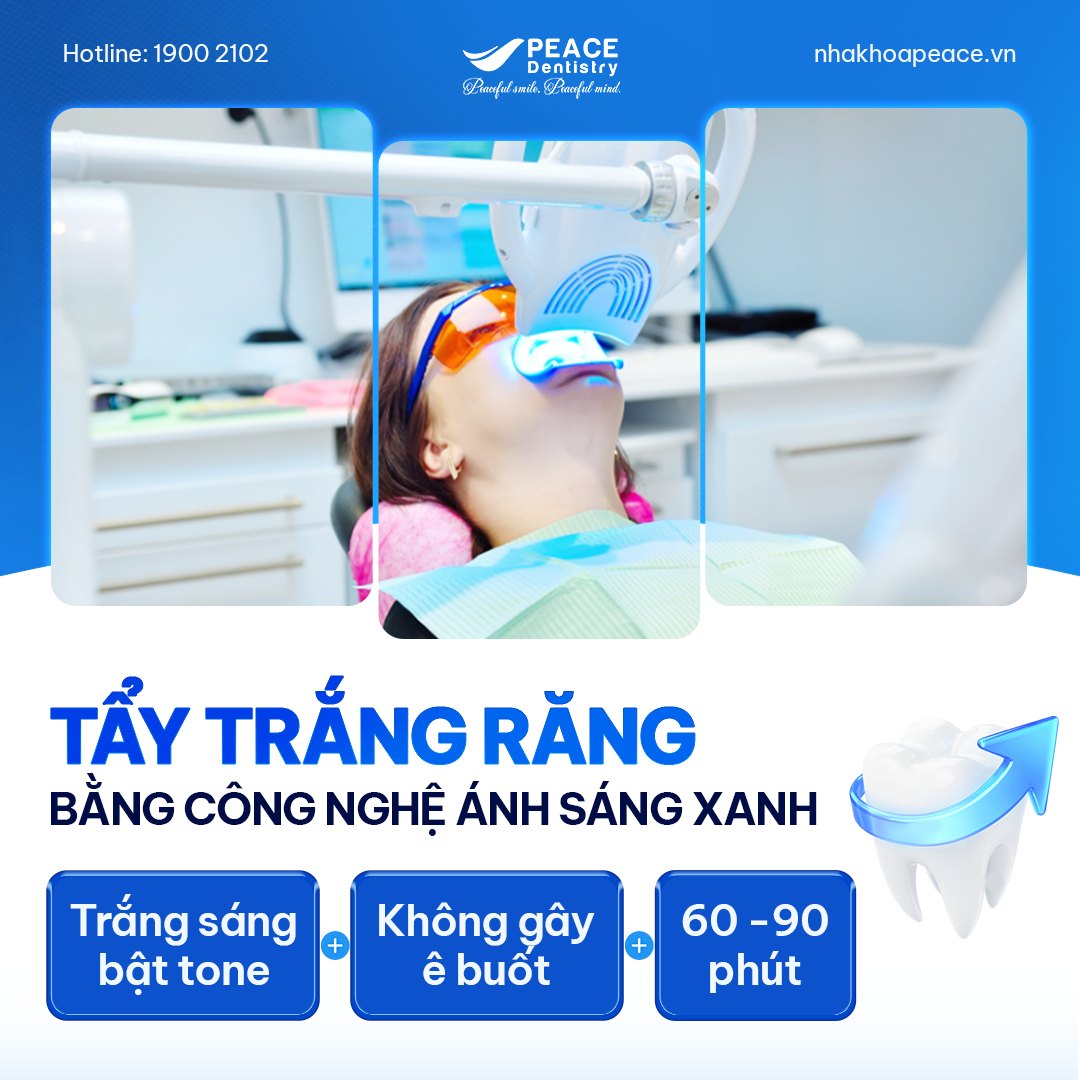 tẩy trắng răng bằng công nghệ ánh sáng xanh