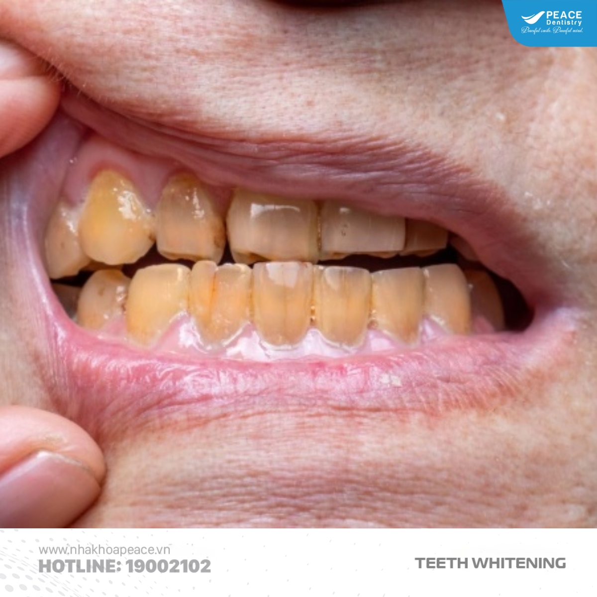 tẩy trắng răng bằng máng ngậm tại nhà