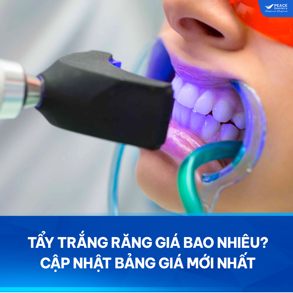 tẩy trắng răng giá bao nhiêu