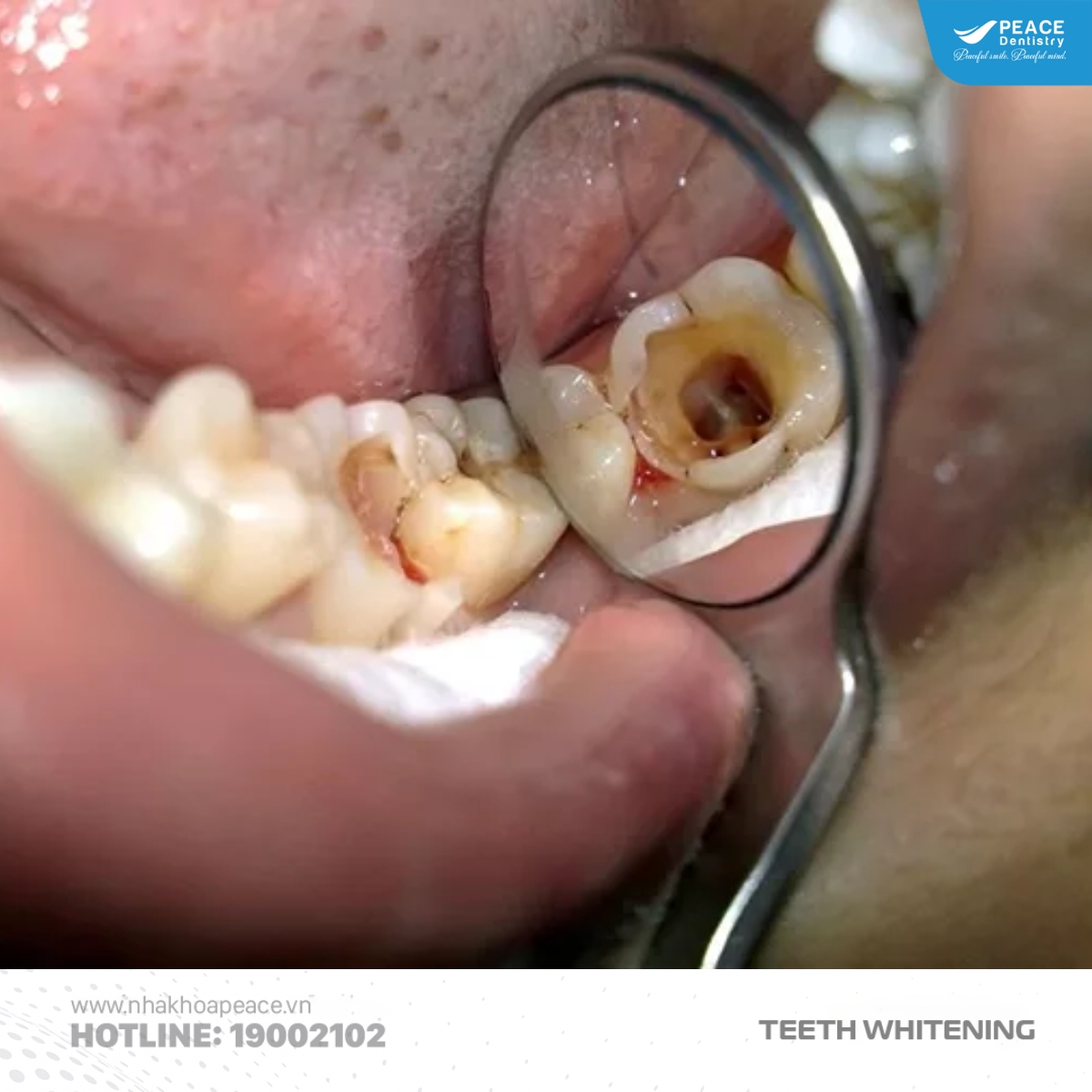 tẩy trắng sai cách ảnh hưởng đến tủy răng